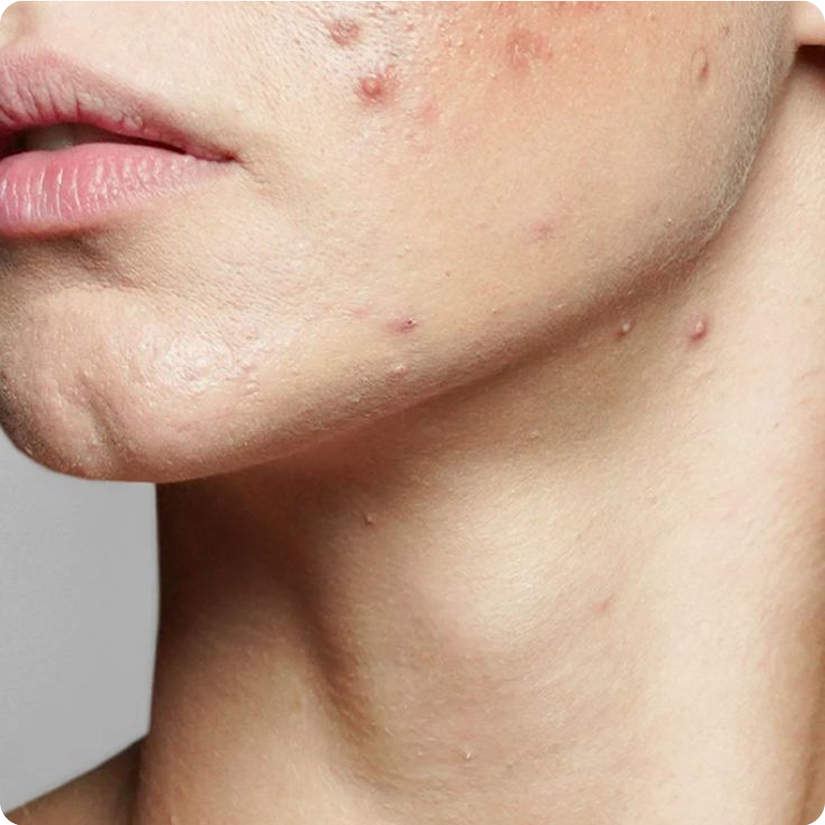 acne_collection.png